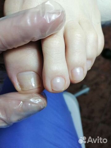 Подолог. Педикюр лечебный /мужской /женский/детски