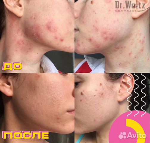 Чистка лица Dr. Weitz Cosmetology