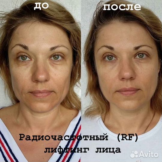 RF лифтинг - красивое лицо без инъекций