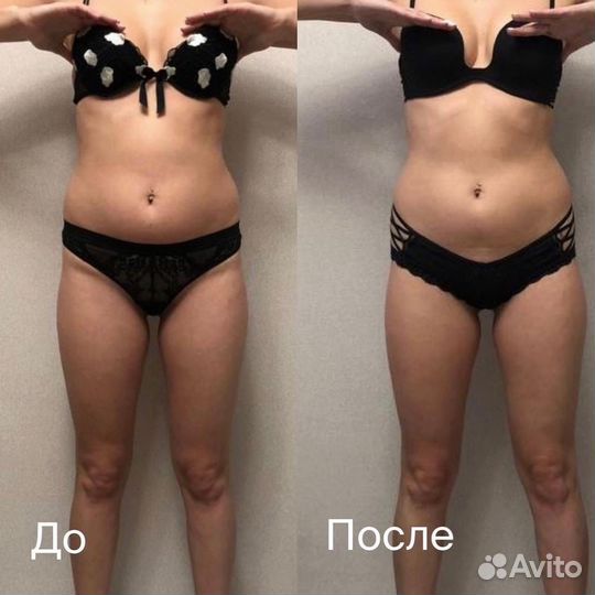 Антицеллюлитный массаж