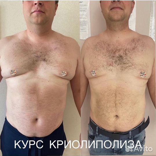 Курс Криолиполиза для мужчин