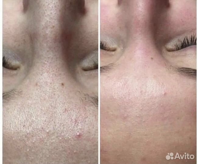 Ультразвуковая чистка лица