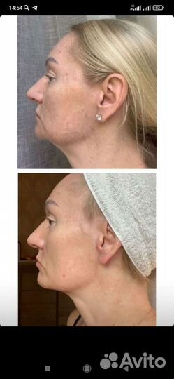 Набор осветляющих кремов evasion depegmentor