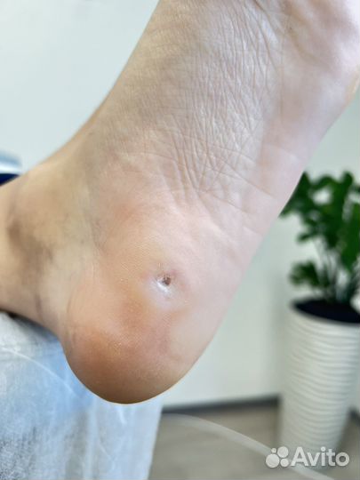 Лечебный педикюр подолог Препаратный педикюр