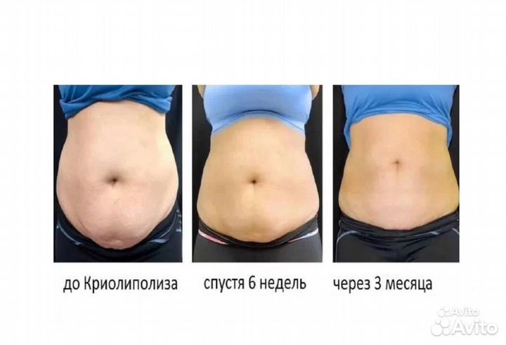 Липосакция без операции в Кирове