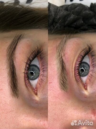 Неодимовый лазер LA15 Nd:YAG