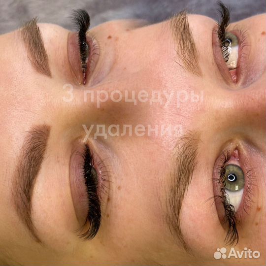 Лазерное удаление татуажа