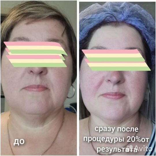 Морщин нет. Подтяну овал,веки. Смас-лифтинг