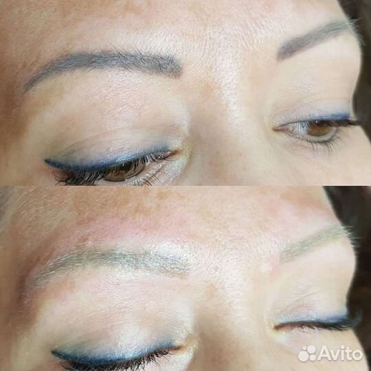 Удаление татуажа