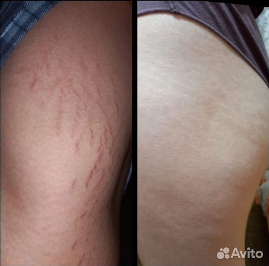 Антицеллюлитный крем