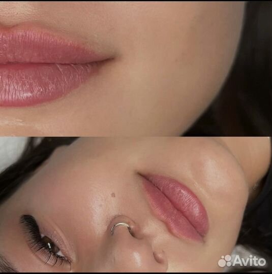 Увеличение губ/Коррекция обьема/Ботокс