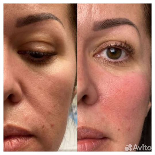 Массаж липопластика лица и тела