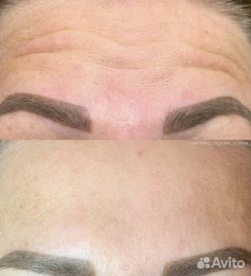 Ботокс для лица