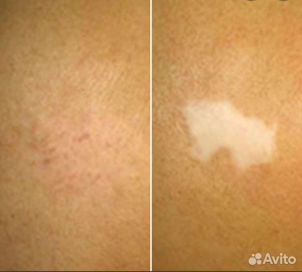 Камуфляж шрамов,растяжек