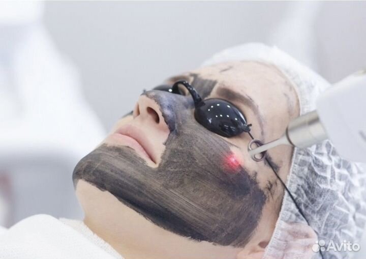 Карбоновый пилинг