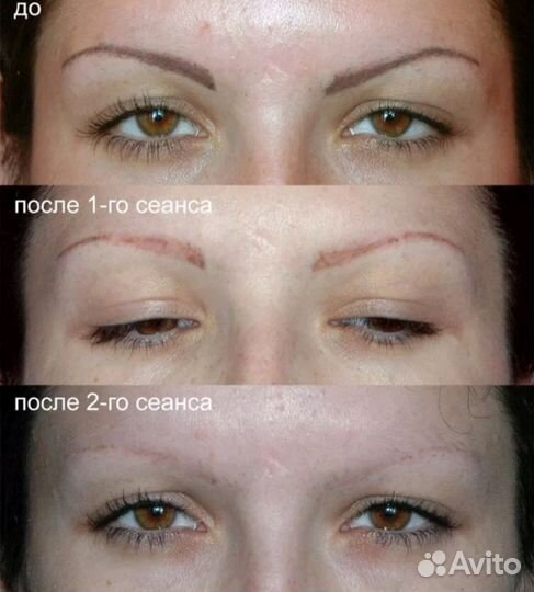 Удаление перманентного макияжа