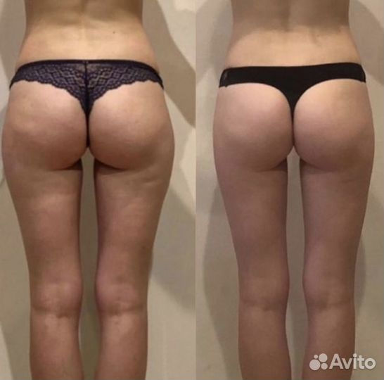 Аппаратная липосакция, liposfera