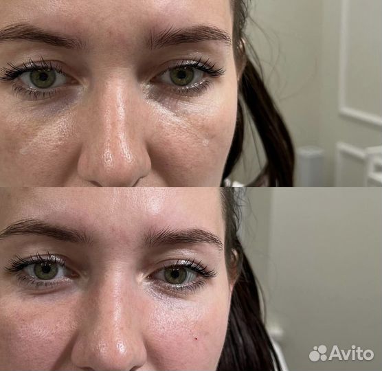 Коррекция носослезной борозды