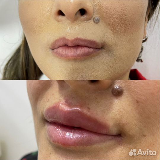 Биоревитализация