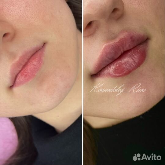 Контурная пластика,увеличение губ,ботокс