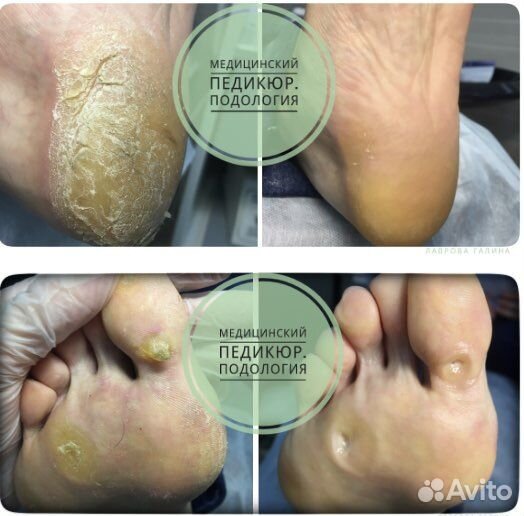 Педикюр, сложные случаи, пластины на ногти