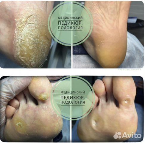 Педикюр, сложные случаи, пластины на ногти