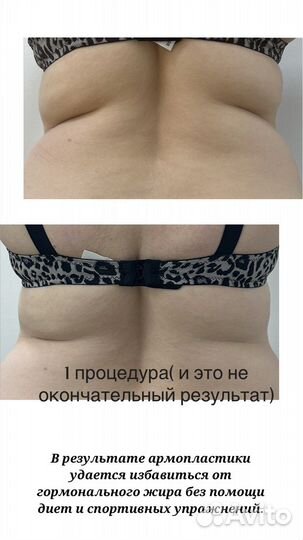 Антицеллюлитный массаж