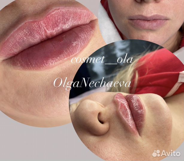 Увеличение губ, удаление филлера из губ