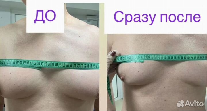 Плоский живот - размер за 1 процедуру