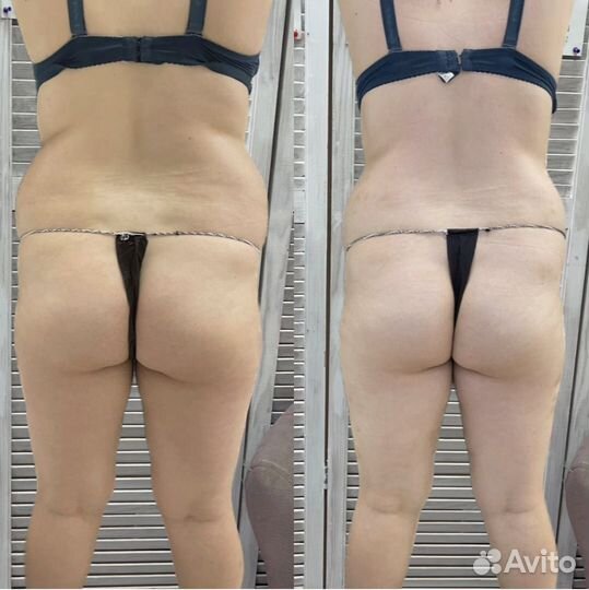 Антицеллюлитный массаж, коррекция фигуры