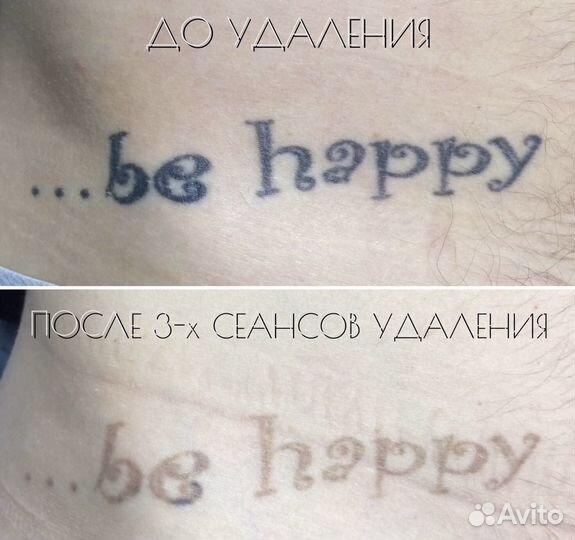 Удаление тату и татуажа в клинике MediOk