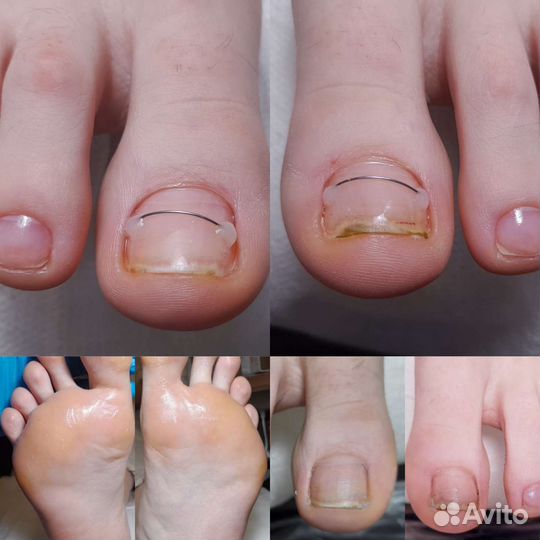Вросший ноготь. Педикюр +для пожилых. Выезд на дом
