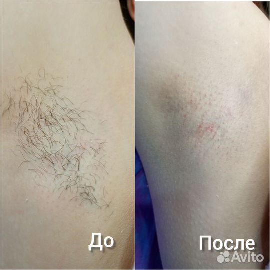 Шугаринг