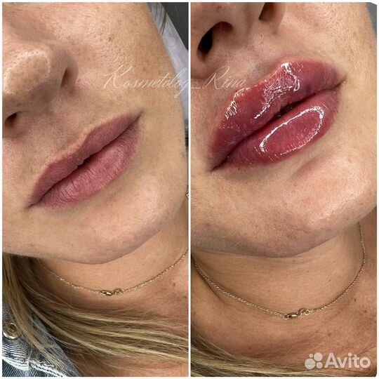 Контурная пластика,увеличение губ,ботокс