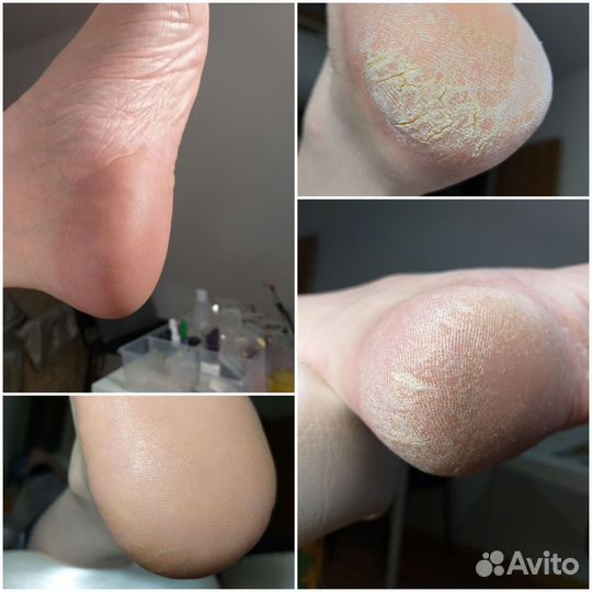 Смарт педикюр