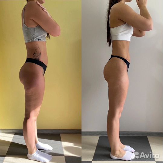 Прессотерапия