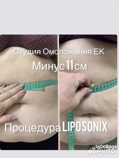 Liposonix Живот+ Бока