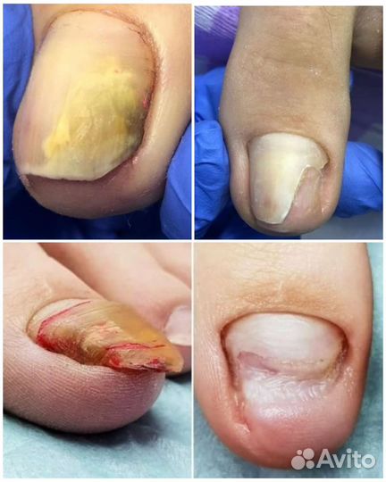 Педикюр, обработка стоп