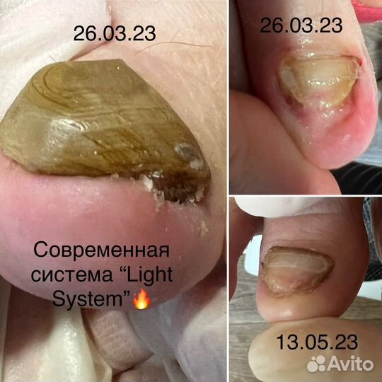 Подолог с выездом на дом