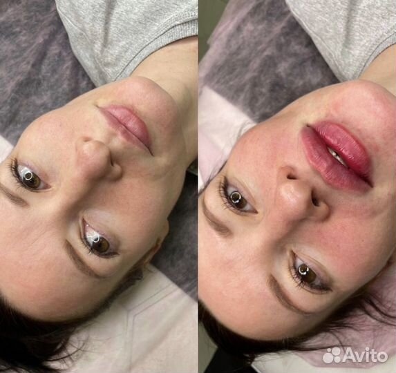 Увеличение губ