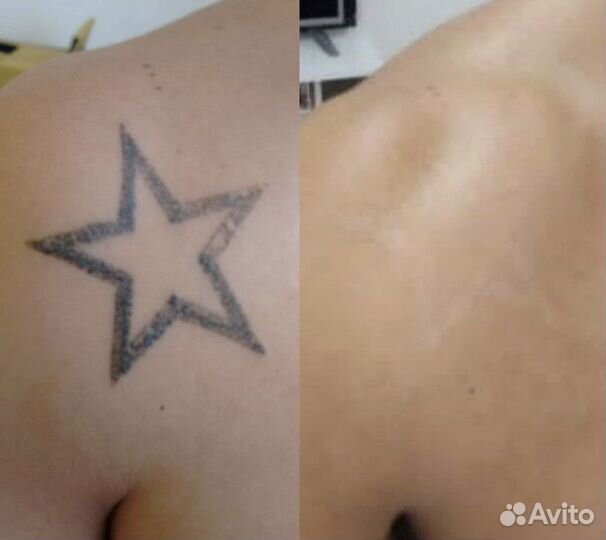 Лазерное удаление татуажа и татуировок