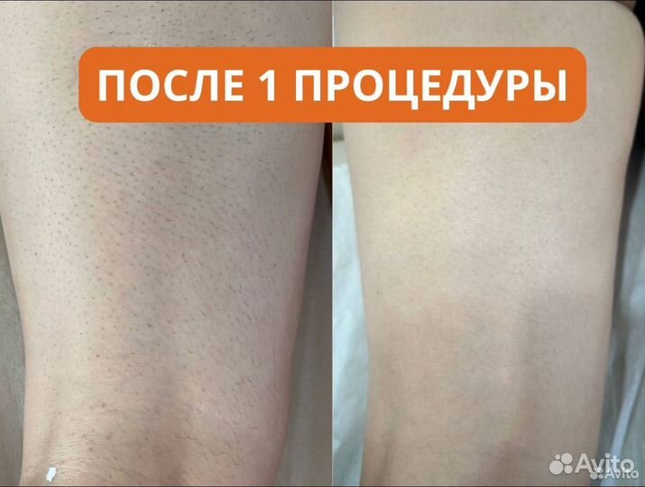 Лазерная эпиляция по супер цене