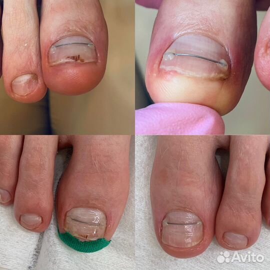 Медицинский педикюр, подолог