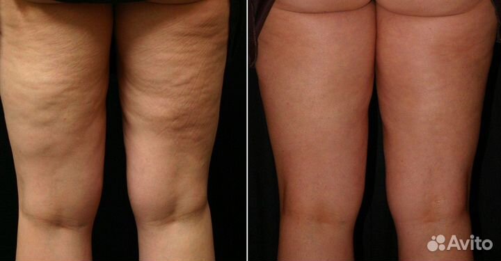 Антицеллюлитный массаж