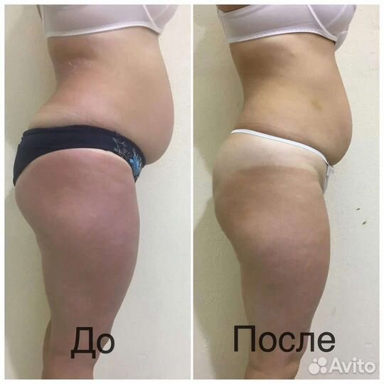 Лпг, Прессотерапия, Скульптурный массаж