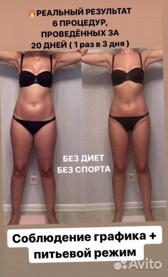 LPG.+Массаж.+Инфракрасный разогрев+Кавитация