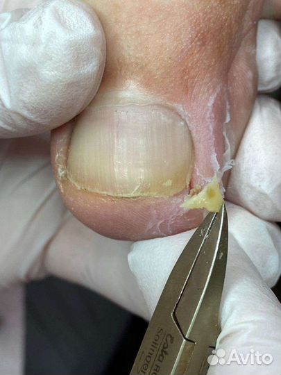 Аппаратный педикюр