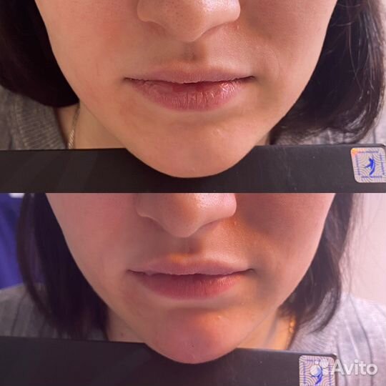 Увеличение губ