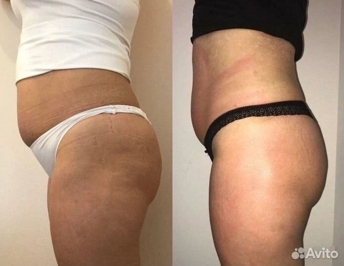 Массаж аппаратный антицеллюлитный