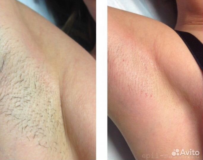 Лазерная эпиляция Элос